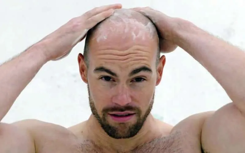 Unlocking the Vital Role of Shampoo for Bald Scalps