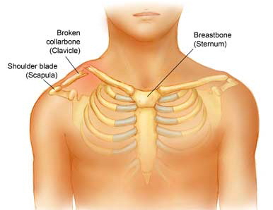 What is the treatment for a broken collarbone