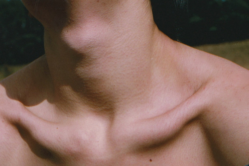 What Are The Causes of Collar Bone Protrusion