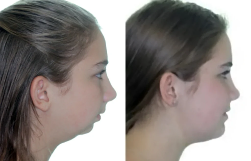 Benefits of Jaw Surgery